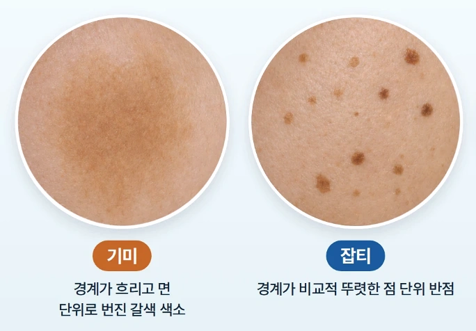 경계가 흐리고 넓게 퍼진 기미와 경계가 비교적 뚜렷한 작은 잡티의 피부 표면 특징을 비교한 확대 사진
