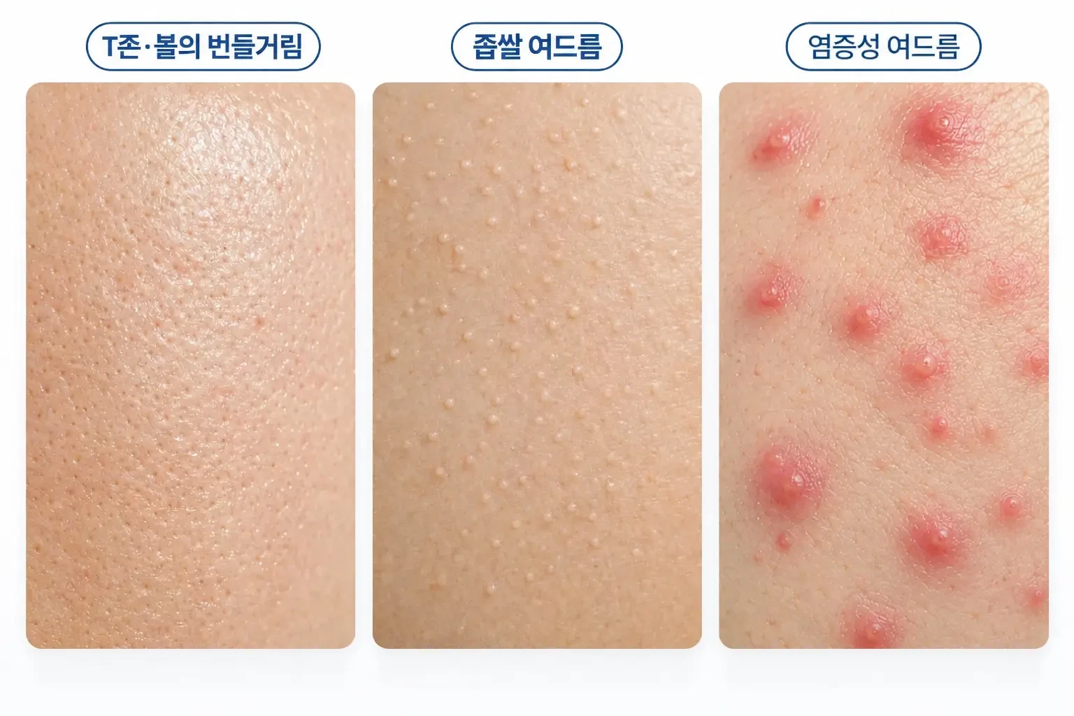 번들거리는 지성 피부, 좁쌀 여드름, 붉은 염증성 여드름의 피부 표면을 나란히 비교한 사진