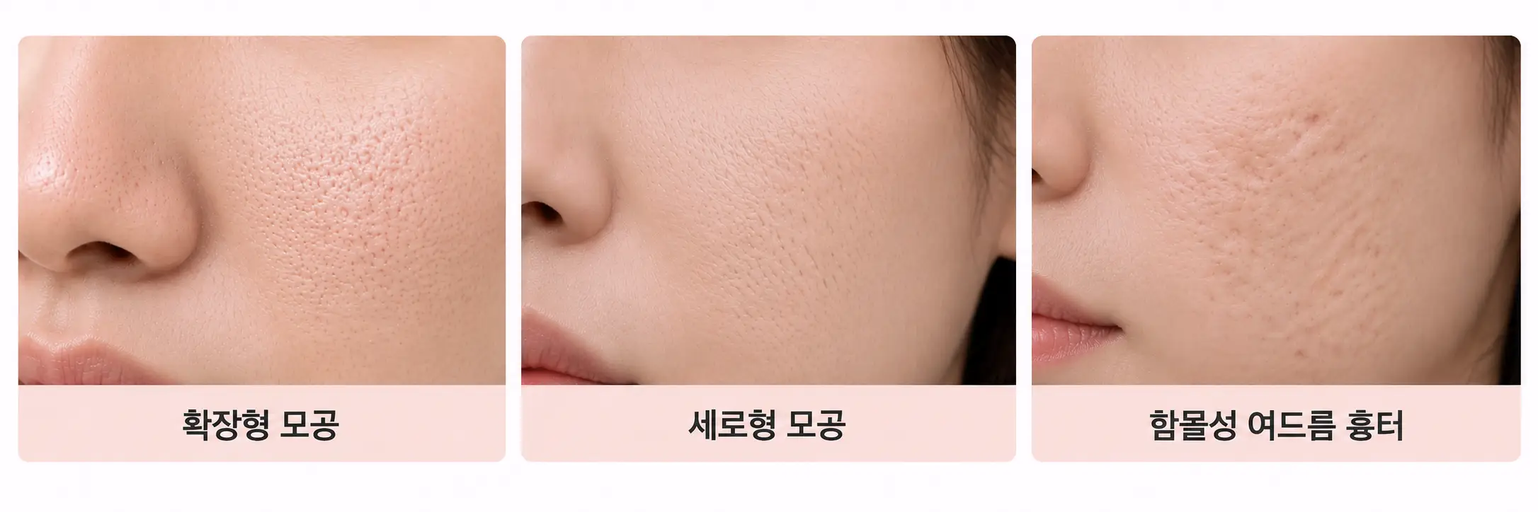 확장형·세로형 모공과 함몰성 여드름 흉터 유형