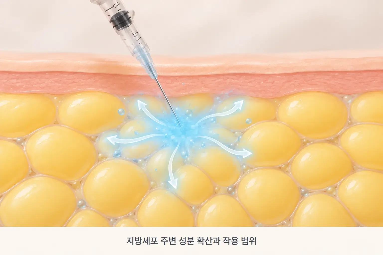 주입된 성분이 피하지방층에 퍼지며 지방세포 주변에 작용하는 모습을 확대한 작용 원리 일러스트
