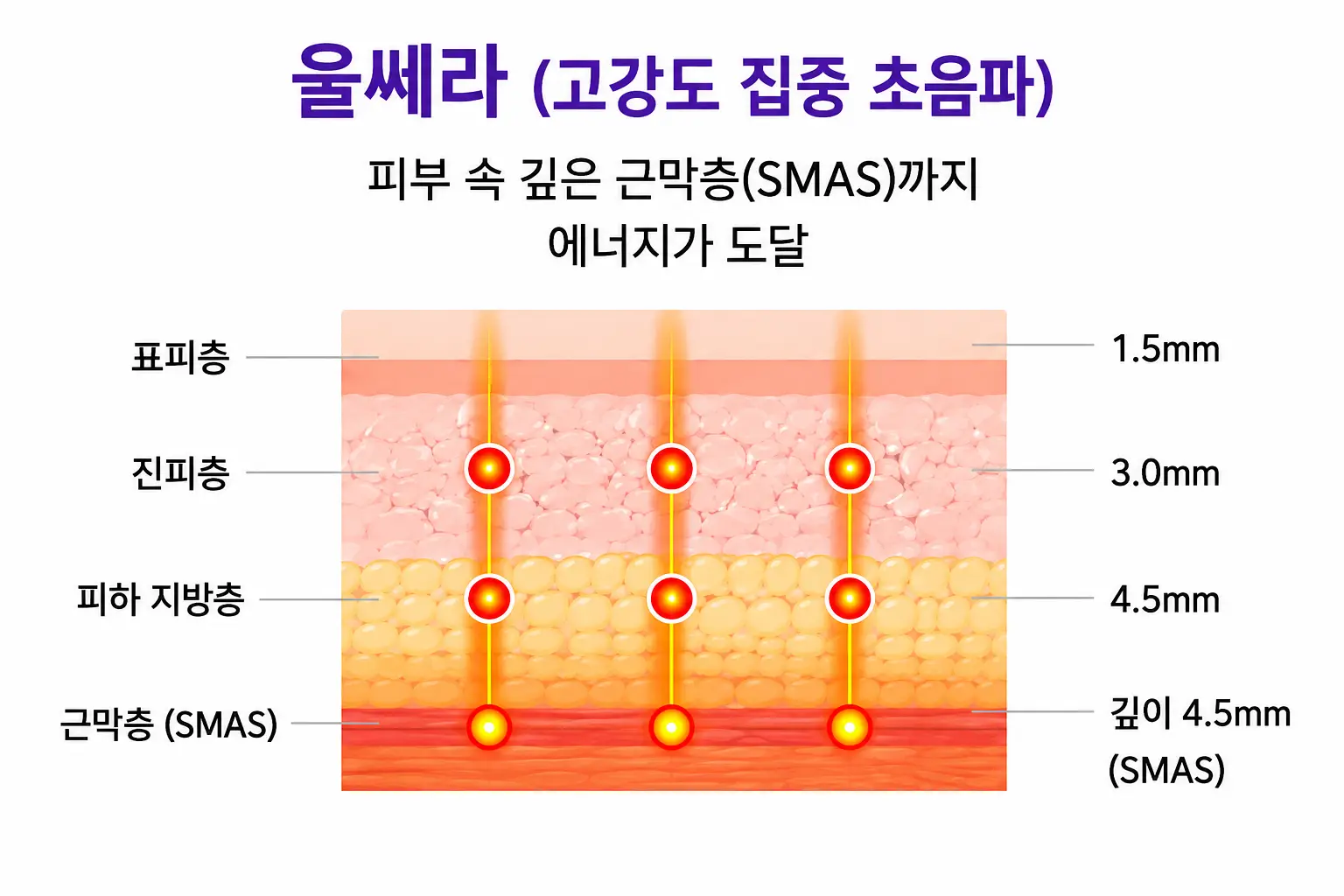 울쎄라 써마지 중 울쎄라 효과를 만드는 초음파 에너지 작용 원리