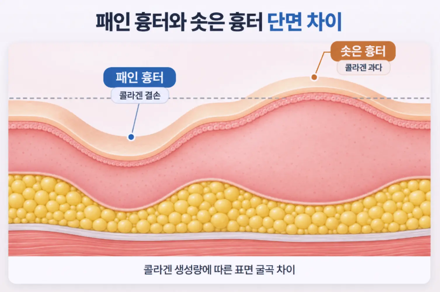 콜라겐 생성량에 따른 패인 위축성 흉터(결손)와 솟은 비후성 흉터(과다)의 피부 단면 구조와 굴곡 차이 일러스트