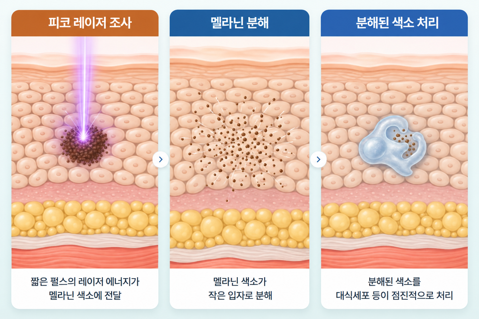 갈색 여드름 자국의 피코 레이저 치료 과정으로 멜라닌 색소에 레이저 조사, 색소 입자의 미세 분해, 대식세포에 의한 색소 처리까지 이어지는 3단계 피부 단면