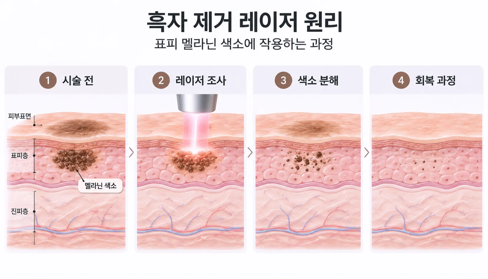흑자 제거 레이저가 표피 멜라닌 색소에 작용하는 원리를 나타낸 피부 단면도