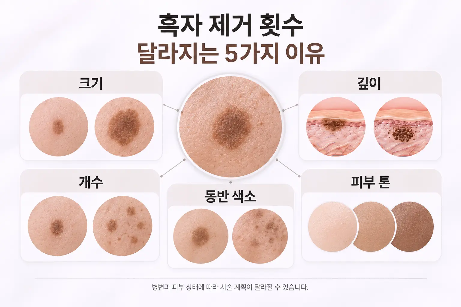 흑자 제거 횟수에 영향을 주는 크기 깊이 개수 동반 색소 피부 톤 요소 정리