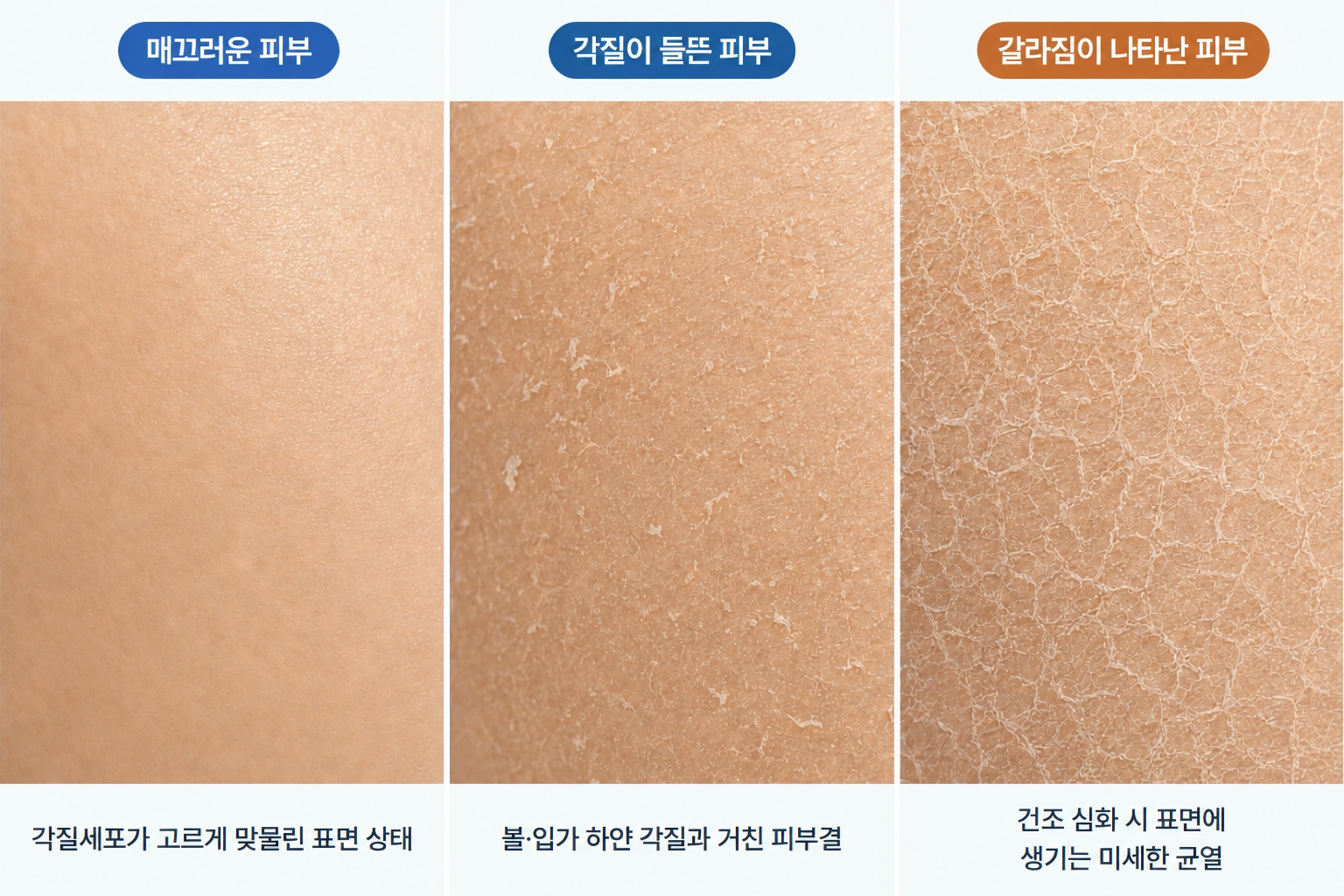 매끄러운 피부, 각질이 들뜬 건조한 피부, 수분 부족으로 미세한 갈라짐이 나타난 피부 표면 비교