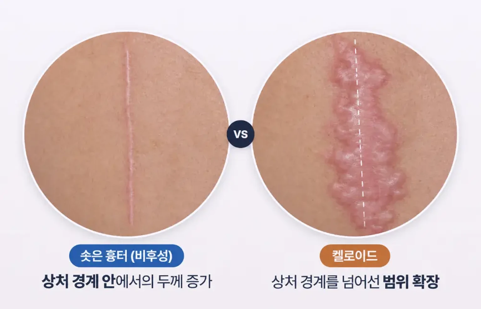 상처 경계 안에 머문 솟은 흉터와 경계를 넘어 확장된 켈로이드를 비교한 피부 근접 사진