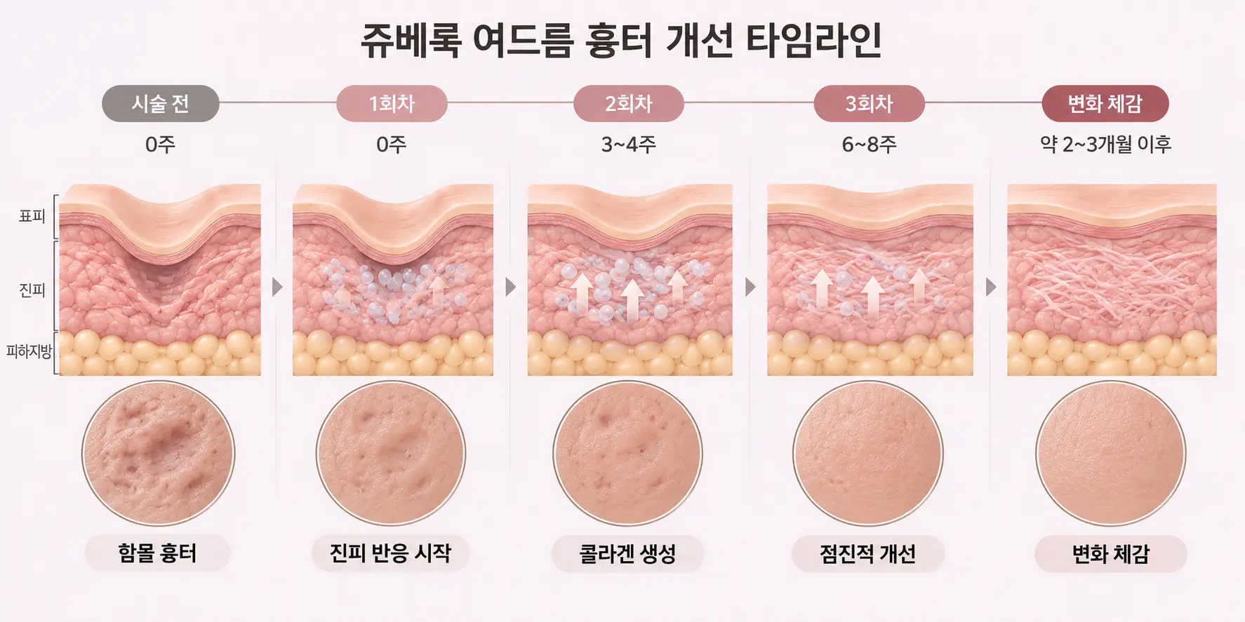 쥬베룩 여드름흉터 시술 회차별 간격과 경과 타임라인