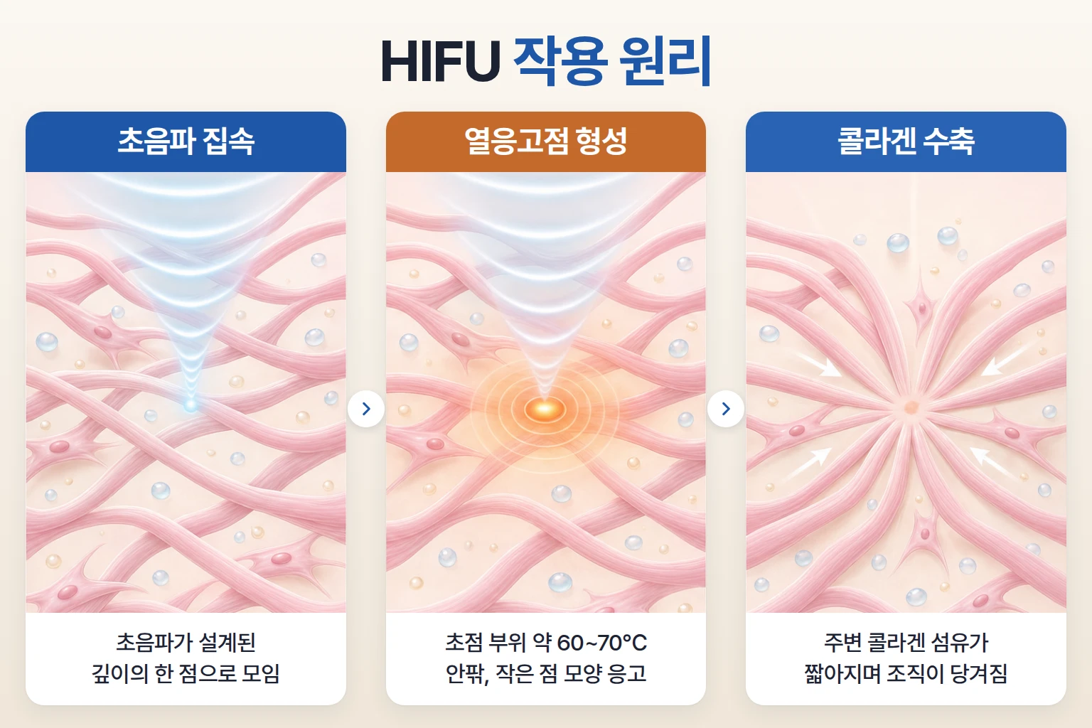 집속 초음파가 한 점에 모여 열응고점을 만들고 콜라겐이 수축하는 과정을 단계별로 나타낸 개념도