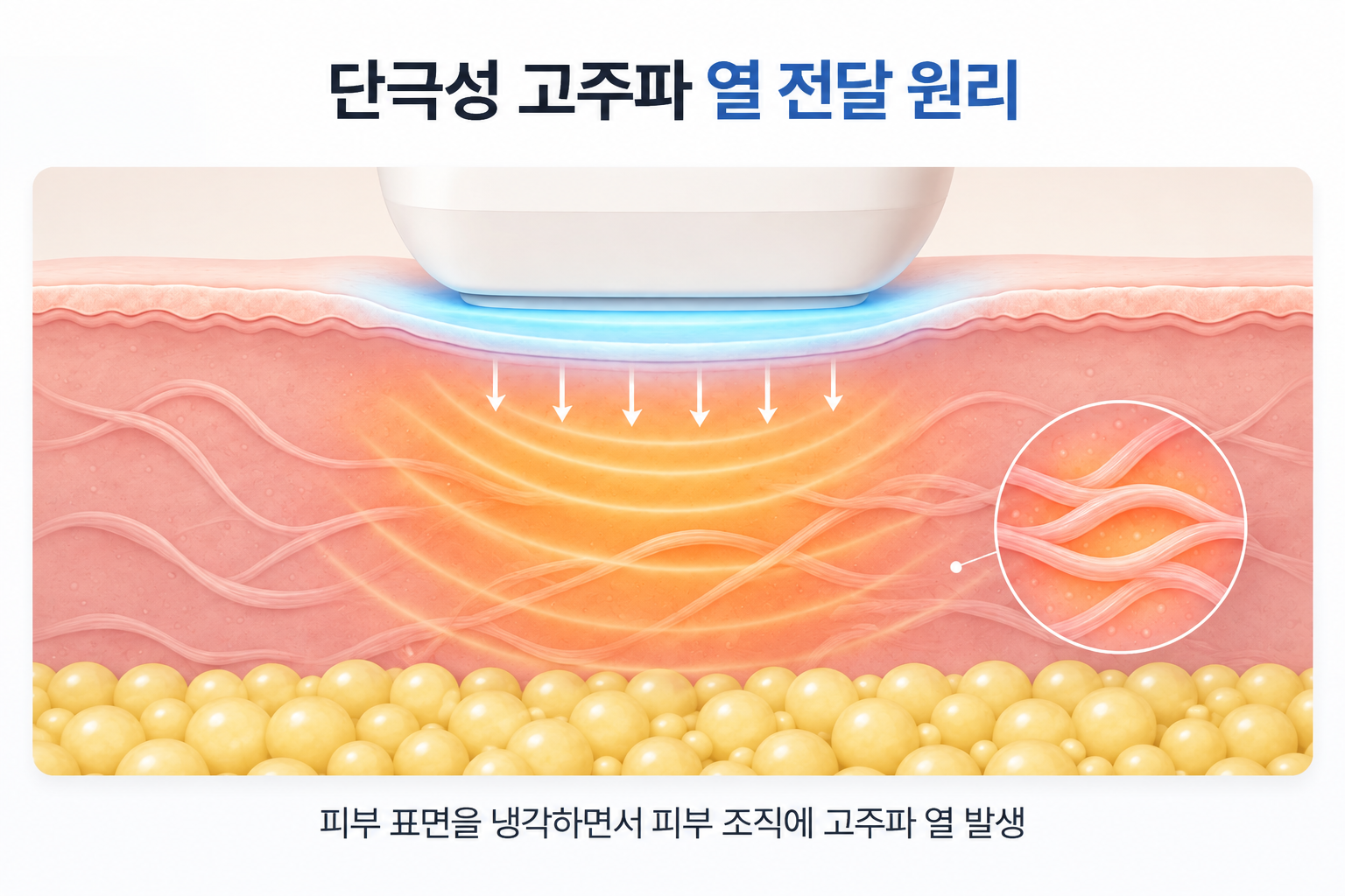 단극성 고주파로 피부 표면을 냉각하면서 피부 조직에 저항열이 발생하는 원리