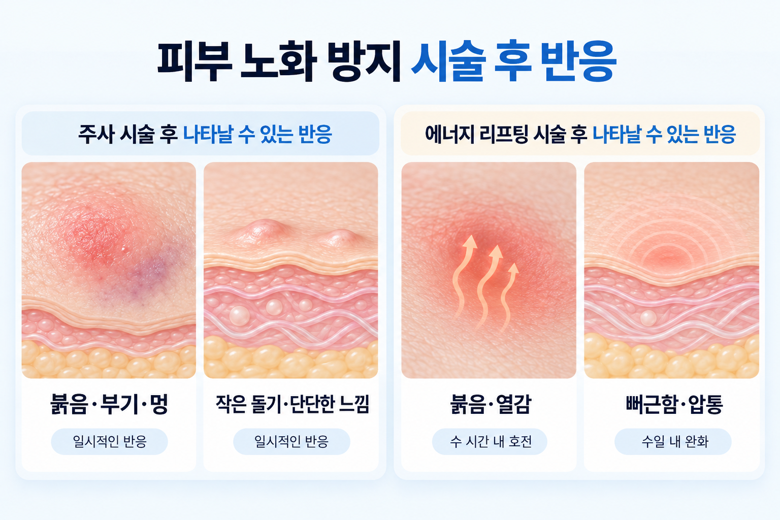 피부 노화 방지 시술 후 나타날 수 있는 붉음 부기 멍 열감 압통