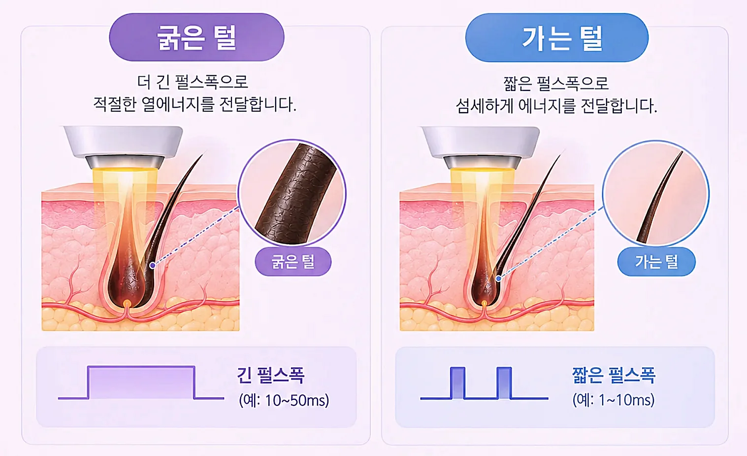 털 굵기에 따른 펄스폭 차이 - 굵은 털과 잔털 대응 개념도