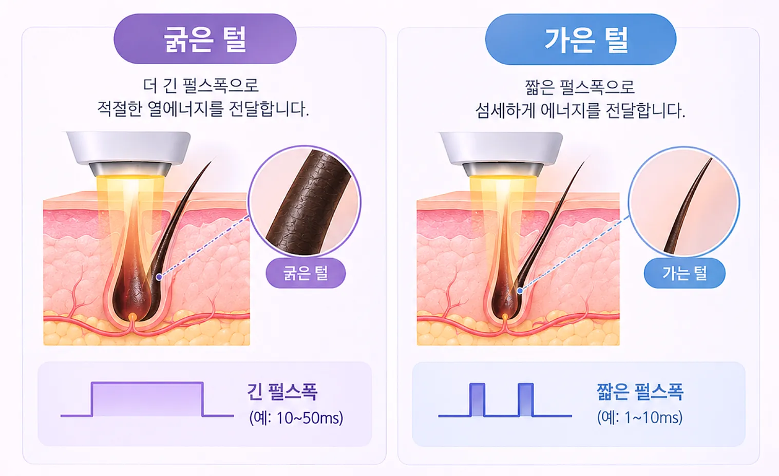 털 굵기에 따른 펄스폭 차이 - 굵은 털과 잔털 대응 개념도