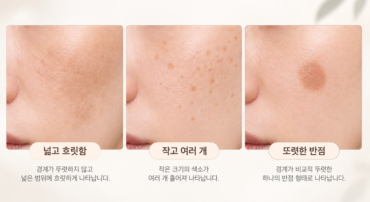 넓고 흐릿한 색소, 작고 여러 개의 갈색 반점, 또렷한 반점 형태 비교
