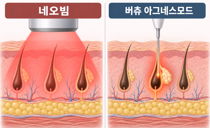 네오빔과 버츄 아그네스모드의 피지선 에너지 전달 방식 비교 모식도