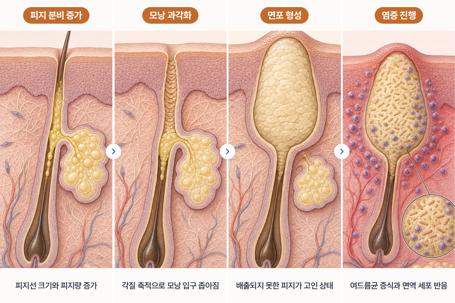 여드름 원인 기전 4단계 피부 단면