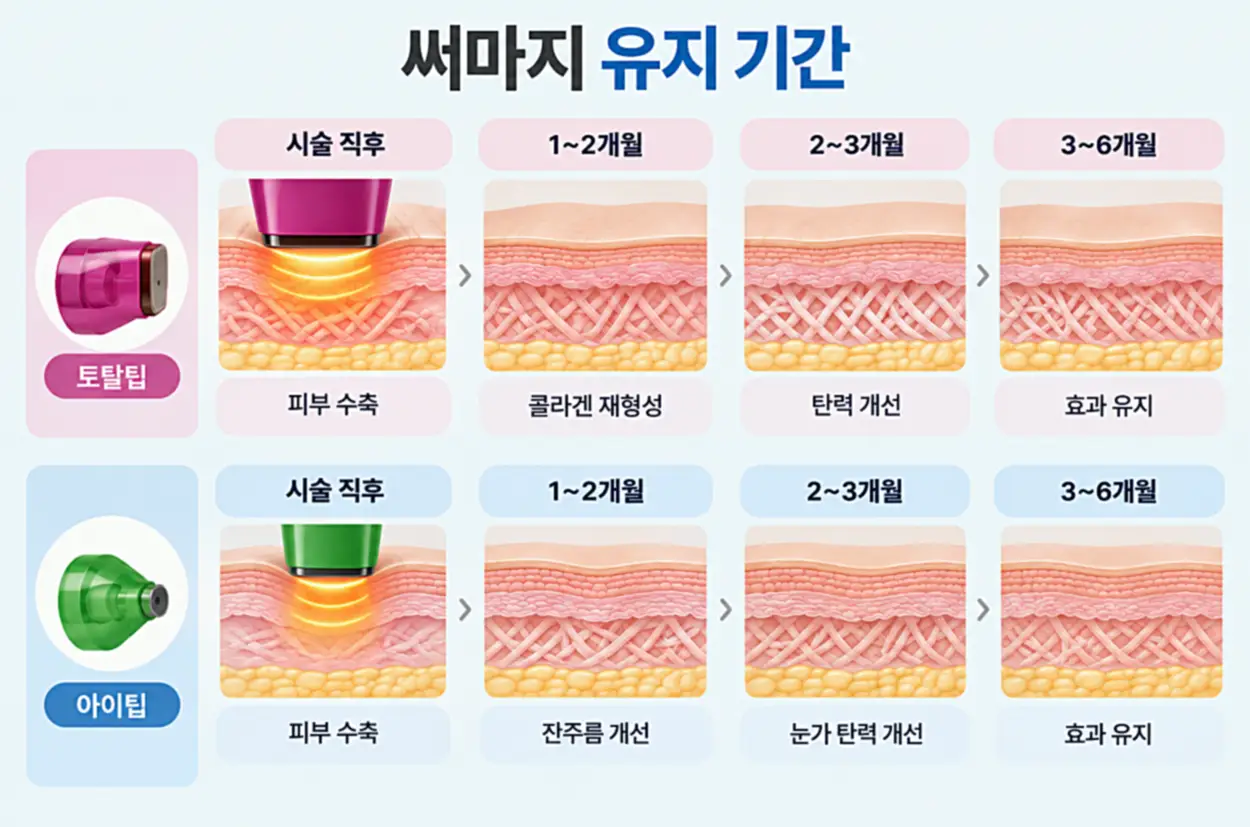 써마지 FLX 토탈팁과 아이팁의 시술 직후부터 1~2개월, 2~3개월, 3~6개월까지 콜라겐 재형성과 피부 탄력 및 잔주름 개선 효과를 비교한 피부 단면도