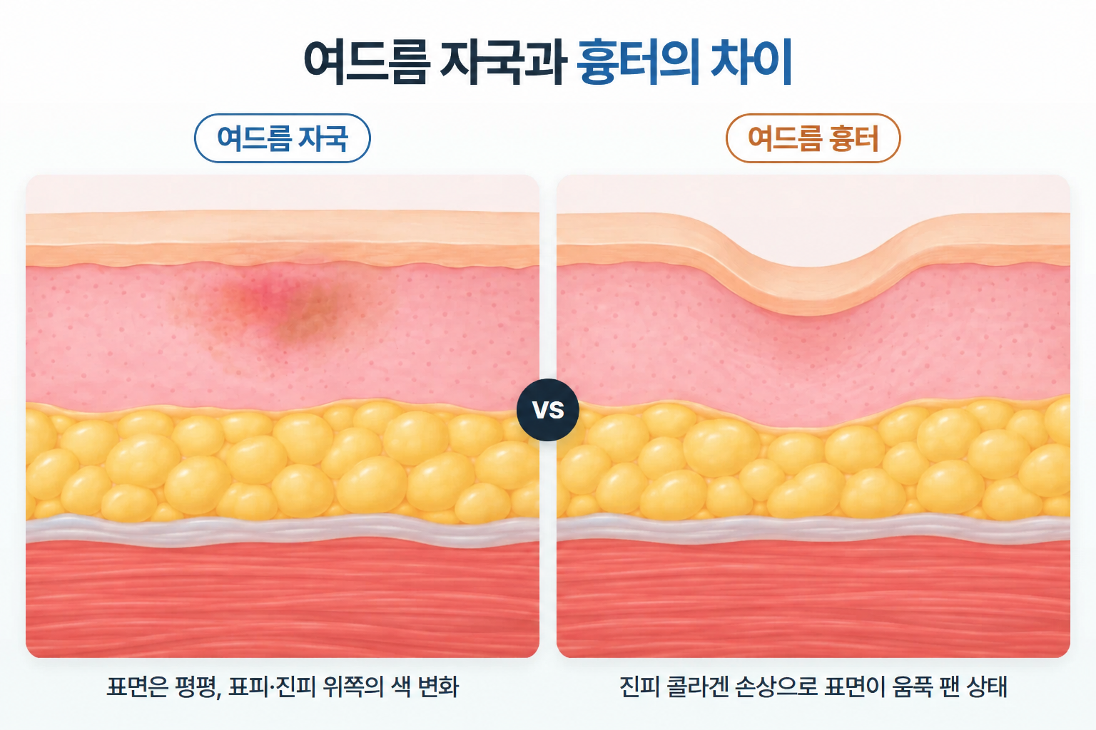 여드름 자국 없애는 법을 주제로 붉은 자국과 갈색 색소침착이 함께 남은 볼 피부와 원형 확대 부위