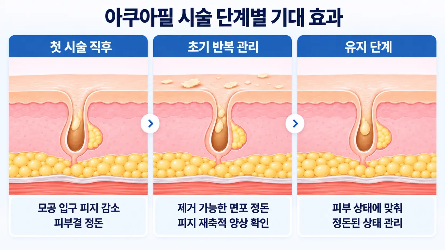 아쿠아필 첫 시술 직후부터 초기 반복 관리와 유지 단계까지 피지 감소, 피부결 정돈, 모공 관리
