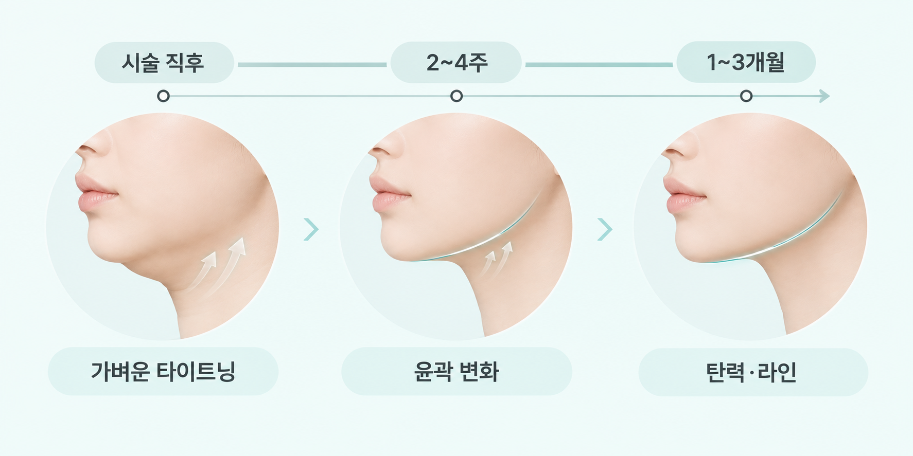 온다리프팅 효과가 시술 직후부터 2~4주, 1~3개월에 걸쳐 나타나는 과정