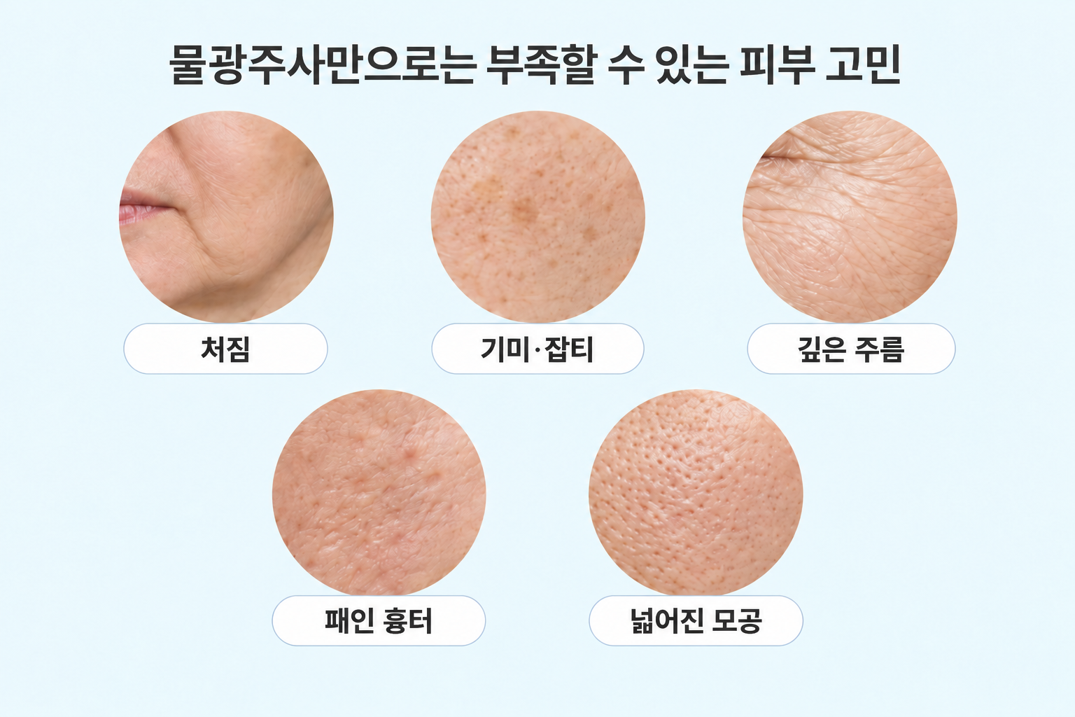 물광주사만으로는 부족할 수 있는 처짐 기미 잡티 깊은 주름 패인 흉터 넓어진 모공