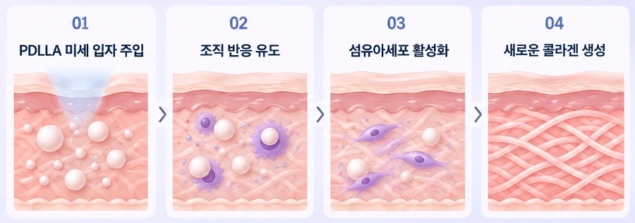 쥬베룩 PDLLA 미세 입자 주입 후 조직 반응과 섬유아세포 활성화 및 콜라겐 생성 과정을 나타낸 이미지