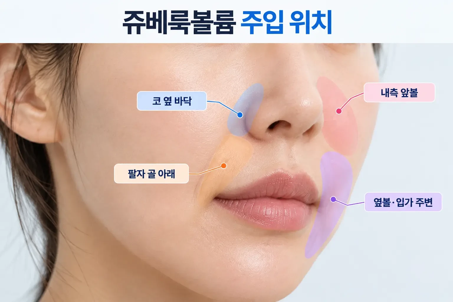 코 옆 바닥, 내측 앞볼, 팔자 골 아래 주입 위치를 파란 점으로 표시한 측면 하관 사진