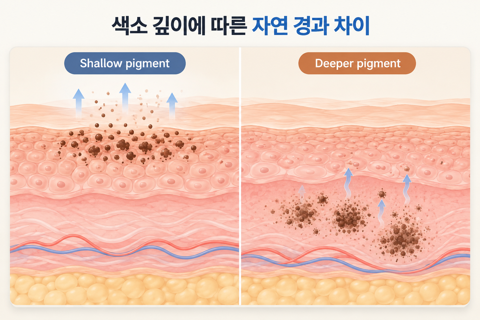 피부 표면 가까운 색소와 깊은 층에 남은 여드름 색소침착의 자연 경과 차이