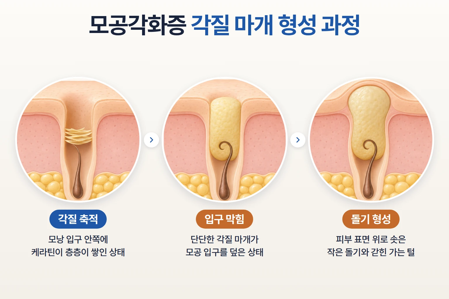 모낭 입구에 케라틴이 쌓여 각질 마개가 생기고 돌기가 솟는 과정을 단계별로 나타낸 단면도