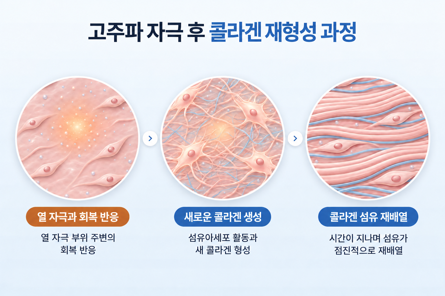 포텐자 효과의 원리인 고주파 열 자극 후 피부 회복 반응, 섬유아세포의 콜라겐 생성, 콜라겐 섬유 재배열의 3단계 과정