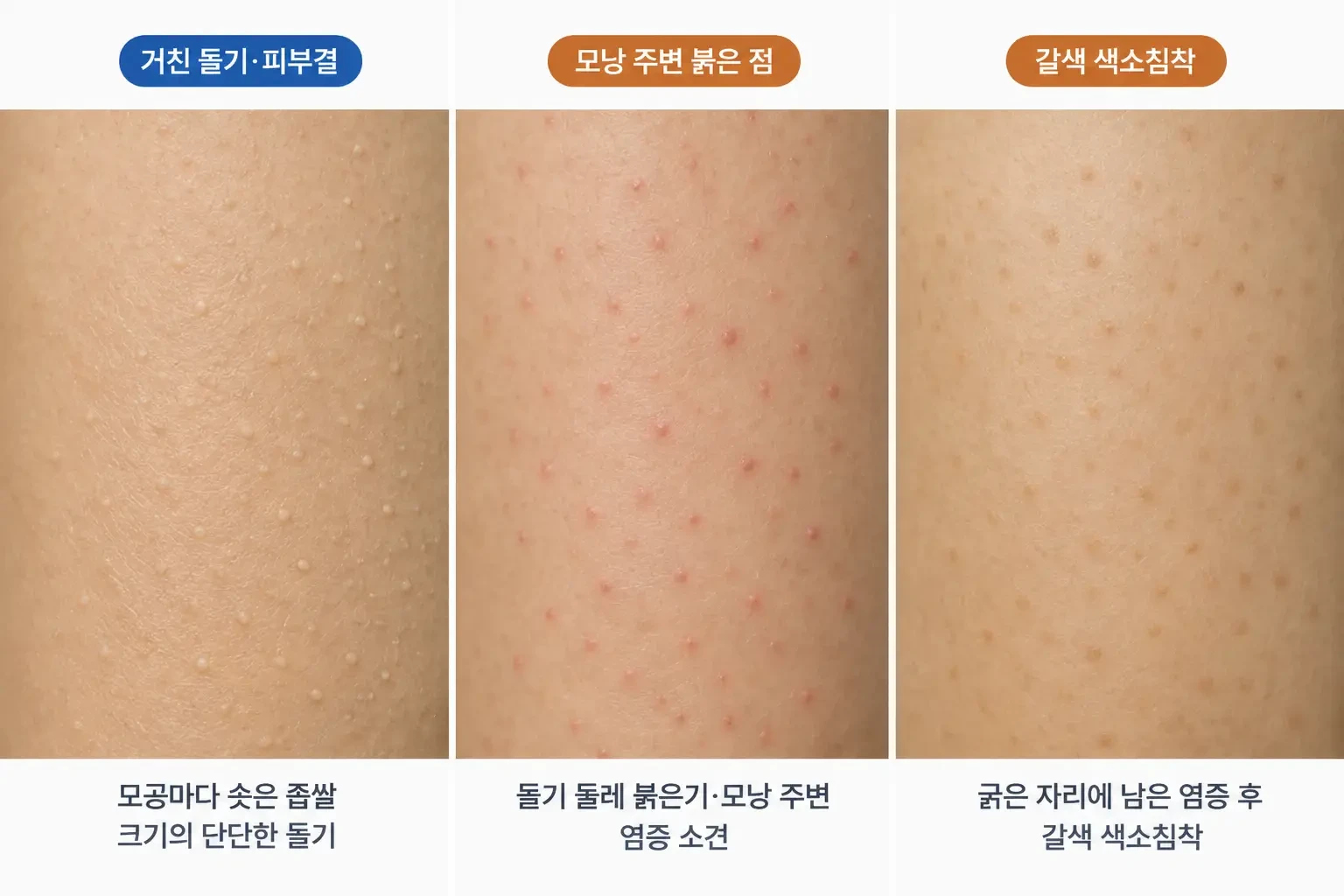 팔 바깥쪽 살색 돌기, 모낭 주변 붉은 점, 긁은 뒤 남은 갈색 자국을 비교한 피부 확대 사진
