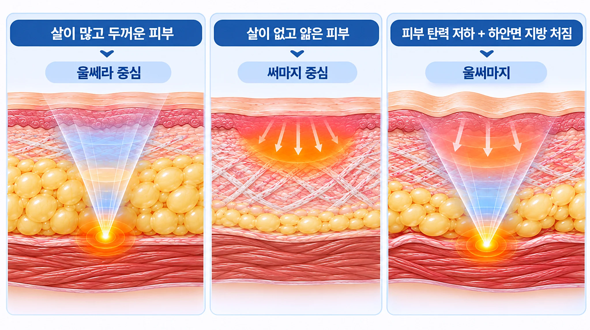 울쎄라, 써마지, 울써마지 적합 피부층 구조와 에너지 전달 방식을 나타낸 메디컬 단면도