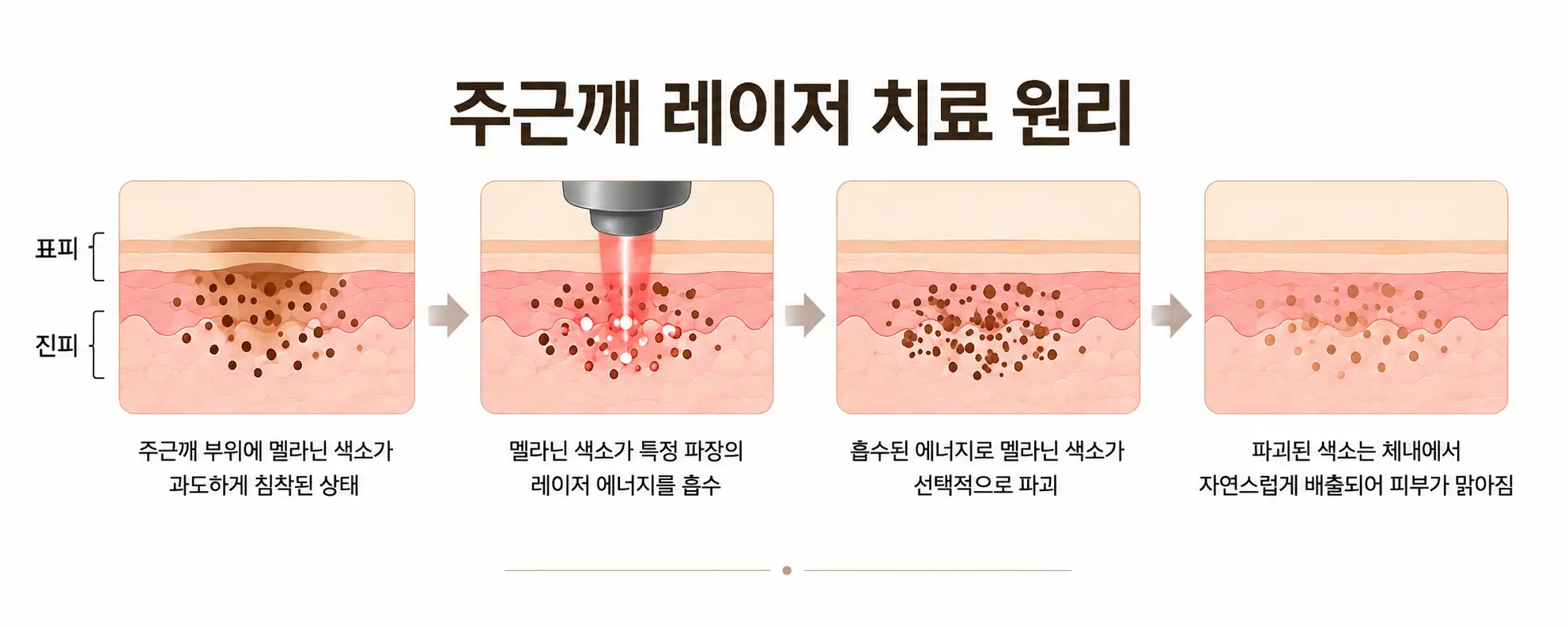 멜라닌 색소에 에너지를 전달하는 주근깨 레이저 치료 원리