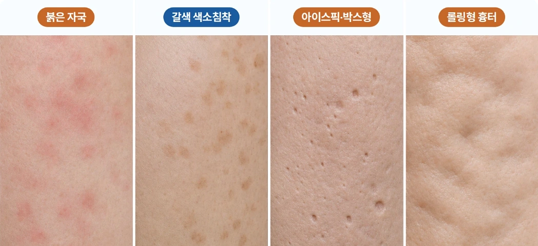 붉은 자국·갈색 색소침착·아이스픽 및 박스형 흉터·롤링형 흉터의 피부 표면 차이를 비교한 이미지