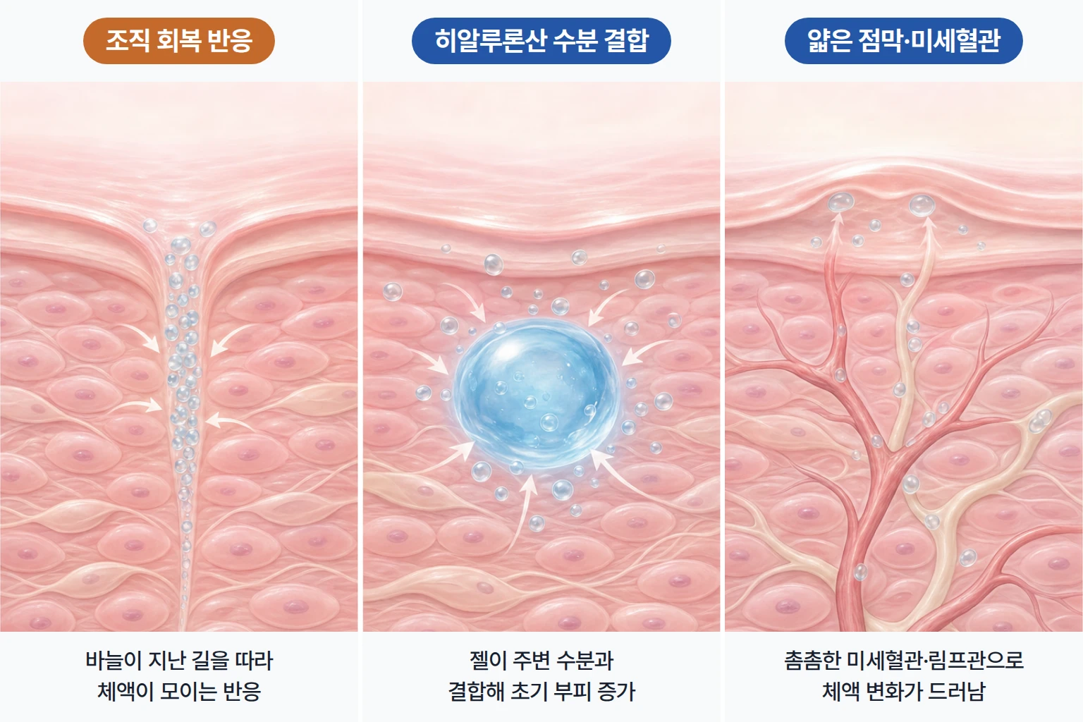 바늘 길을 따라 모인 체액, 히알루론산 젤의 수분 결합, 입술 미세혈관을 나타낸 개념도