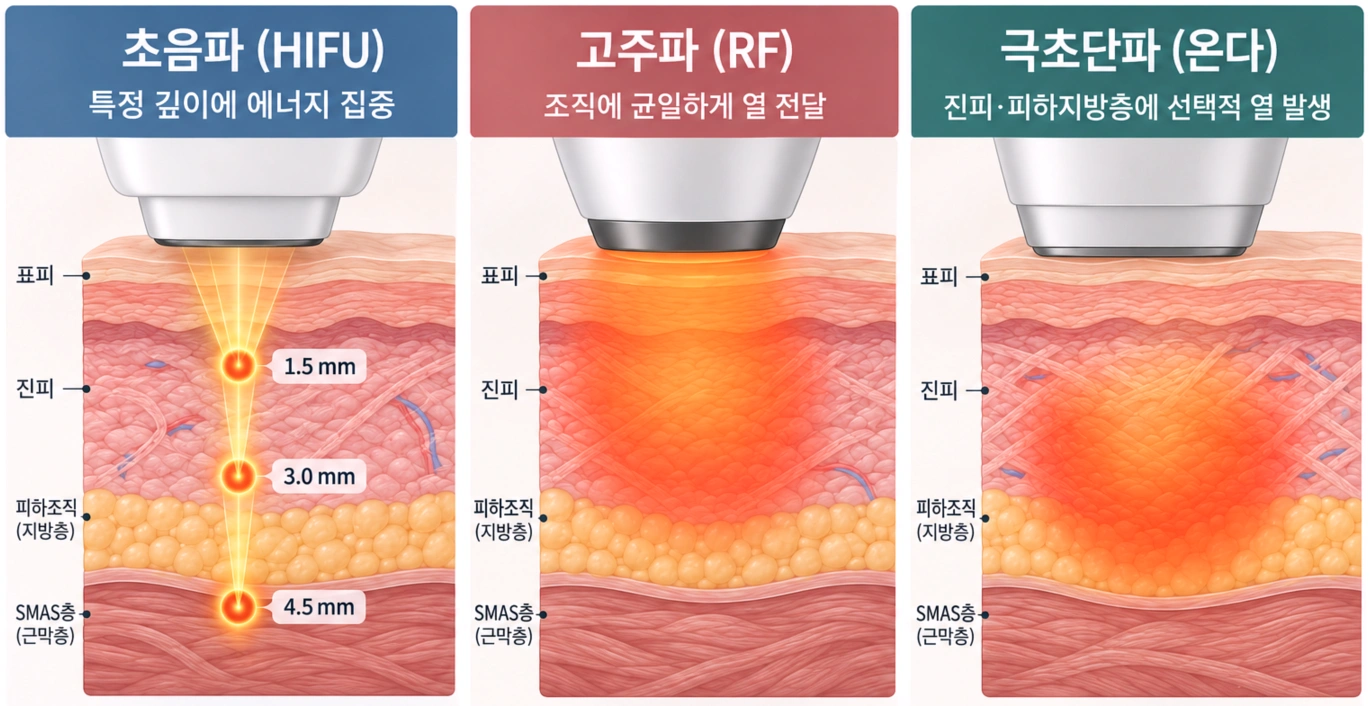 초음파 HIFU, 고주파 RF, 극초단파 온다의 피부층별 에너지 전달 방식을 비교한 단면도