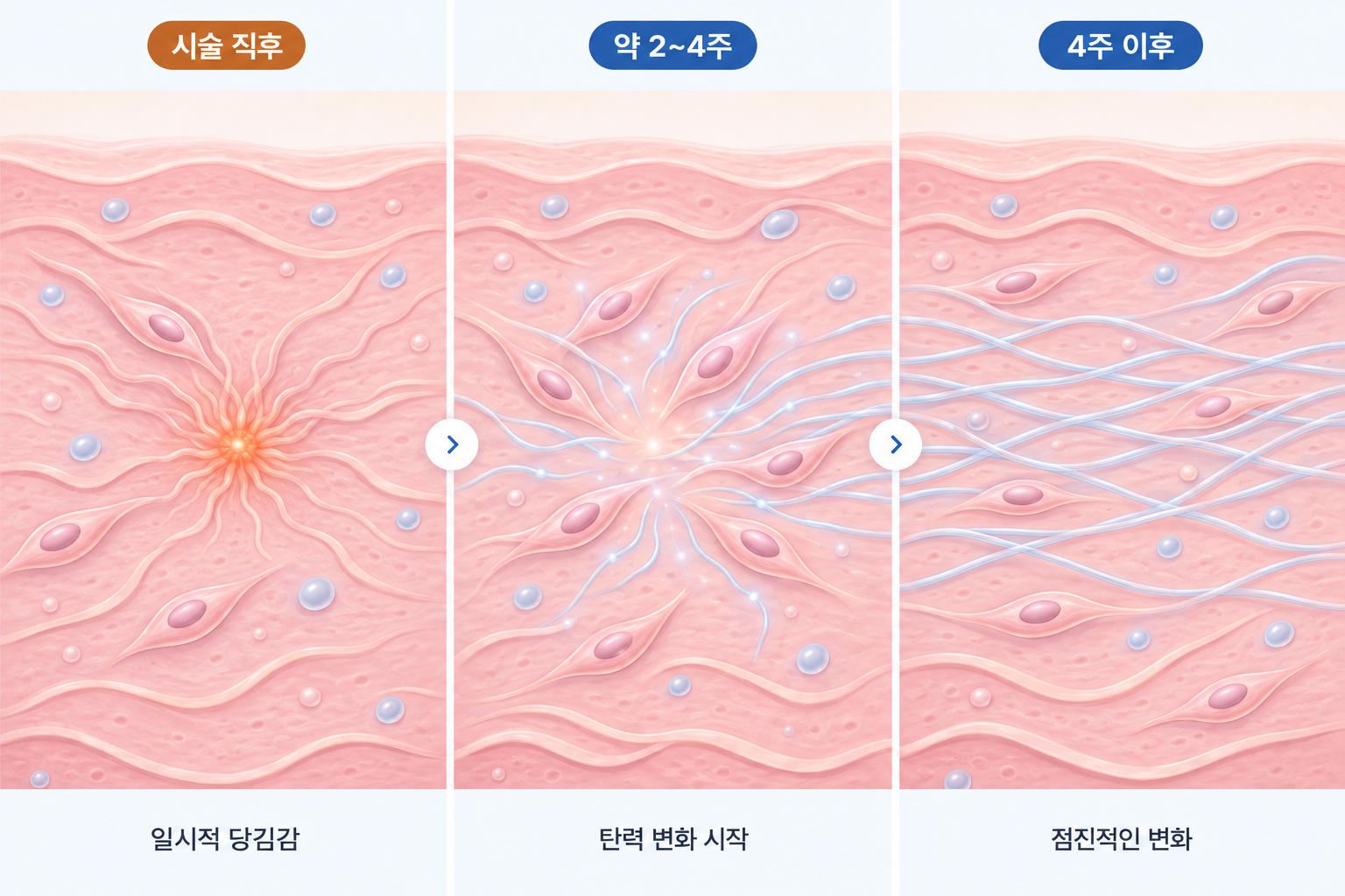 리프테라 효과는 약 2~4주부터 나타나며 이후에도 콜라겐 재구성 진행