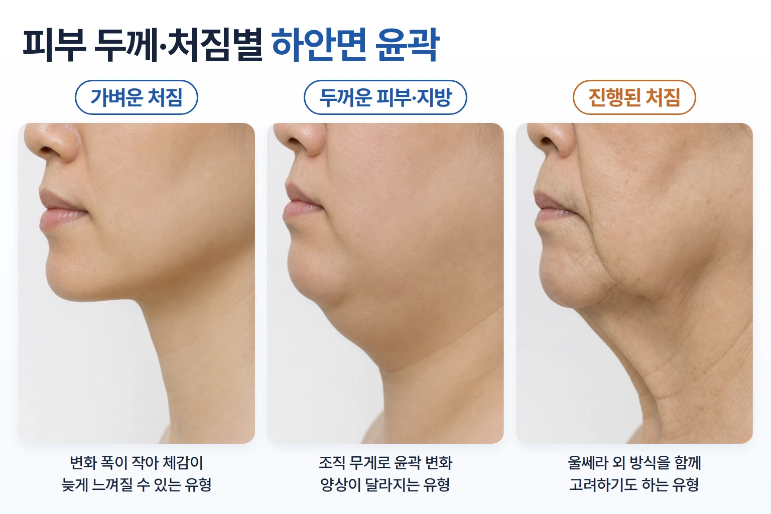 피부 두께와 처짐 정도가 다른 세 가지 하안면 윤곽을 같은 각도에서 담은 측면 비교 사진