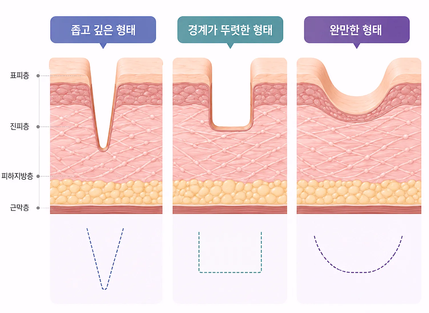 여드름 흉터 형태별 단면 비교 - 깊이와 경계에 따른 구분