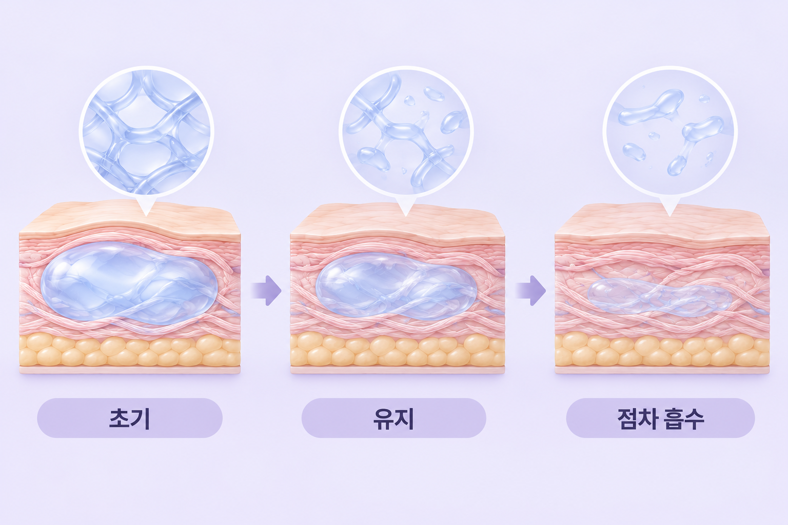 쥬비덤 히알루론산 필러가 초기 볼륨에서 유지 과정을 거쳐 점차 흡수되는 피부 단면도