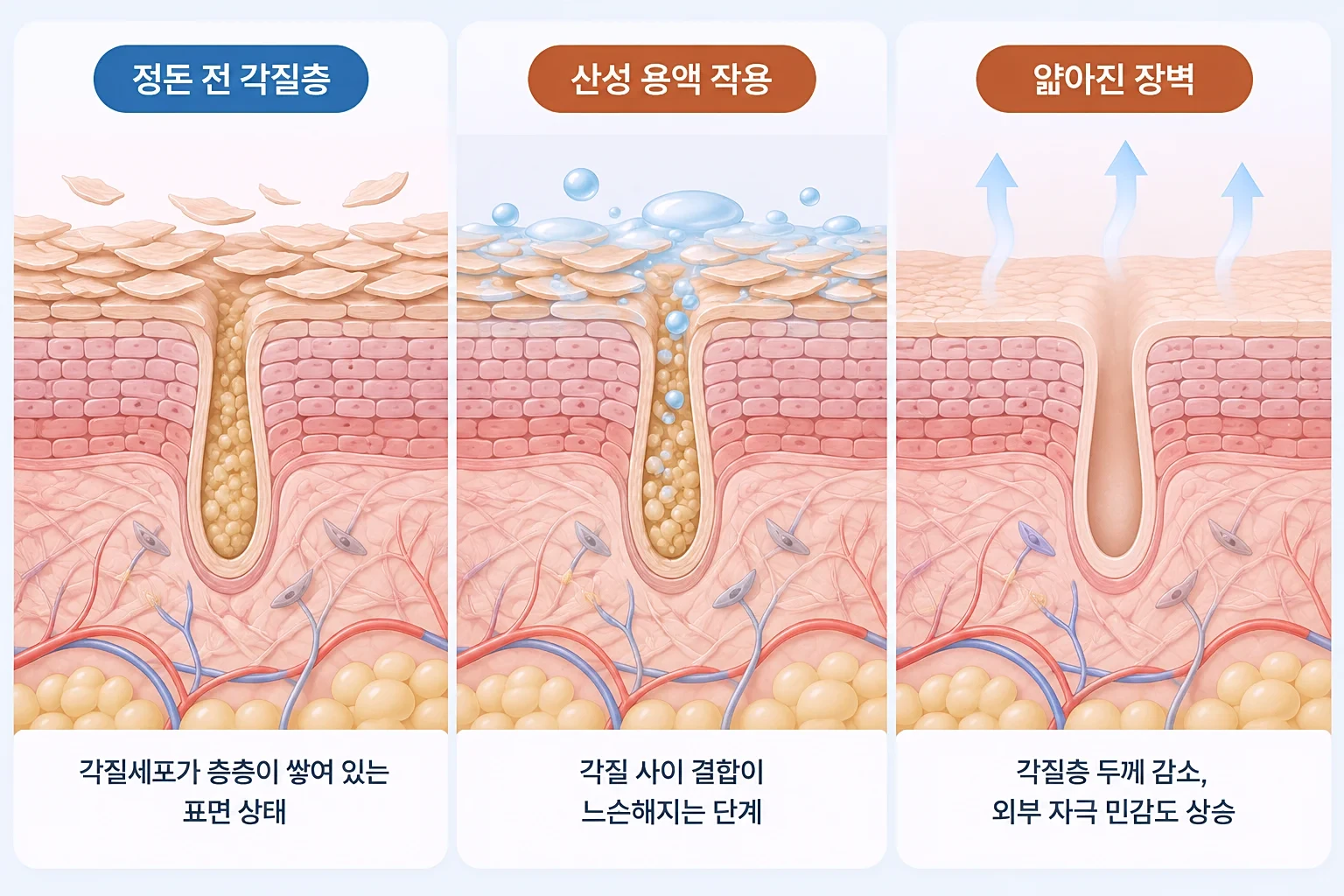 AHA·BHA 용액으로 각질층이 느슨해지고 얇게 정돈되는 단계를 비교한 피부 단면 모식도