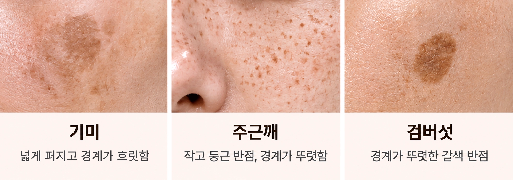기미·주근깨·검버섯의 색상과 경계, 분포 형태 차이를 실제 피부 사진으로 비교한 이미지