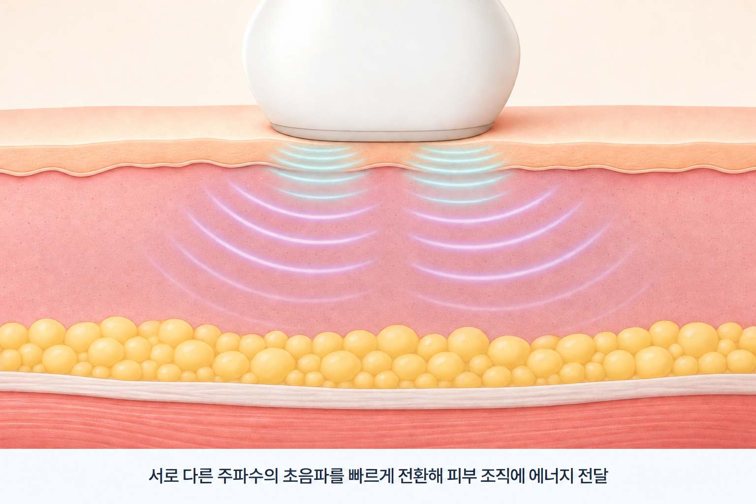 피부결 개선을 위한 LDM 초음파 관리 원리, 피부에 접촉한 탐촉자에서 서로 다른 주파수의 초음파 에너지가 조직으로 전달되는 과정