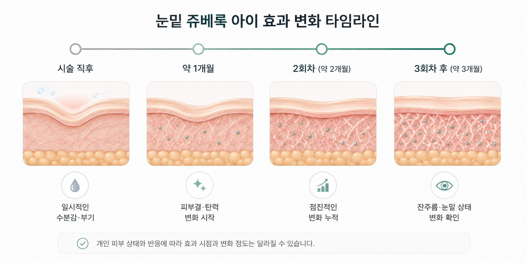 눈밑 쥬베룩 시술 직후부터 약 1개월, 2회차, 3회차 후까지 피부 변화 시점을 나타낸 타임라인