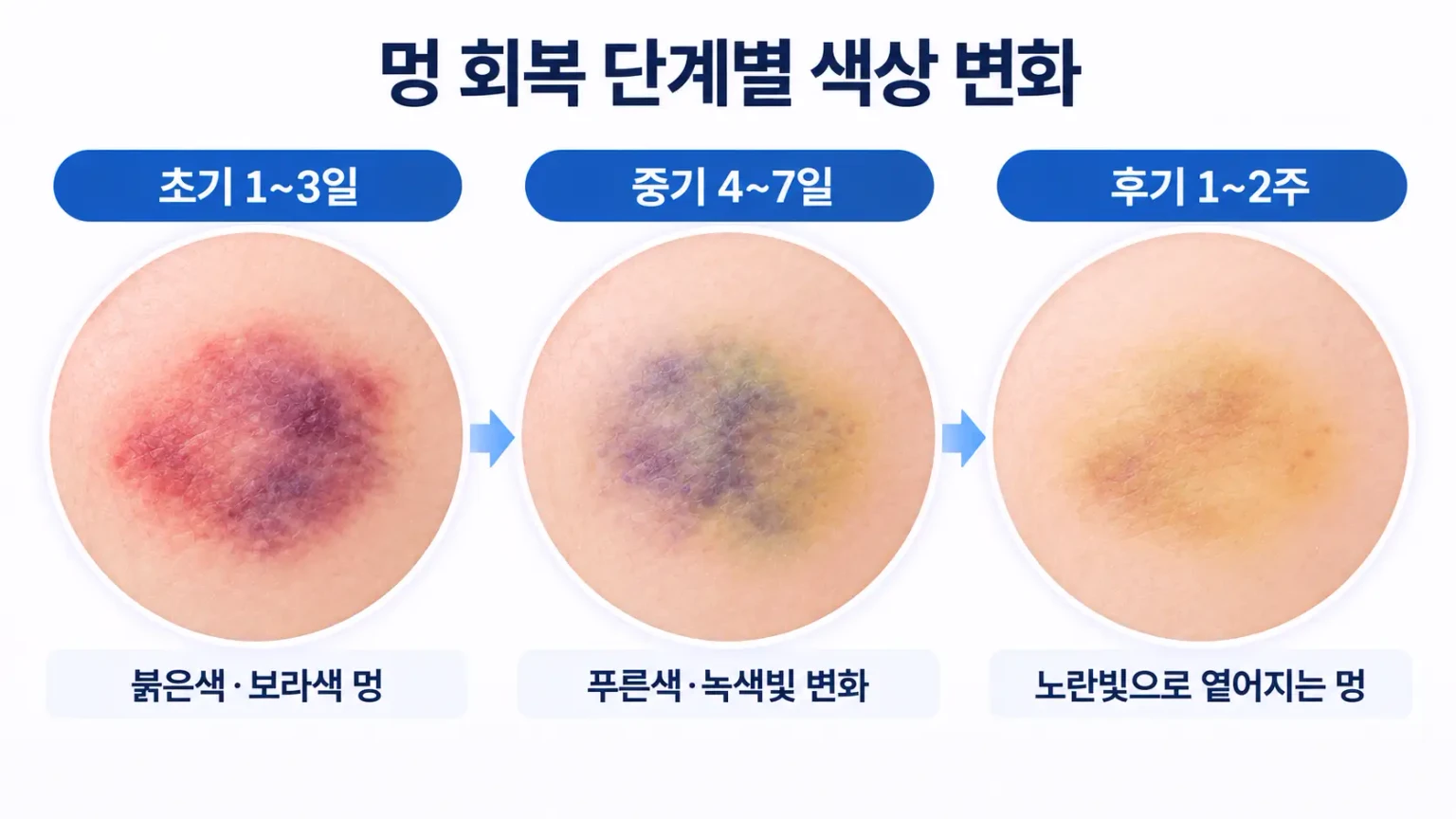 멍 회복 기간에 따른 붉은색, 보라색, 녹색, 노란색의 단계별 색상 변화 일러스트