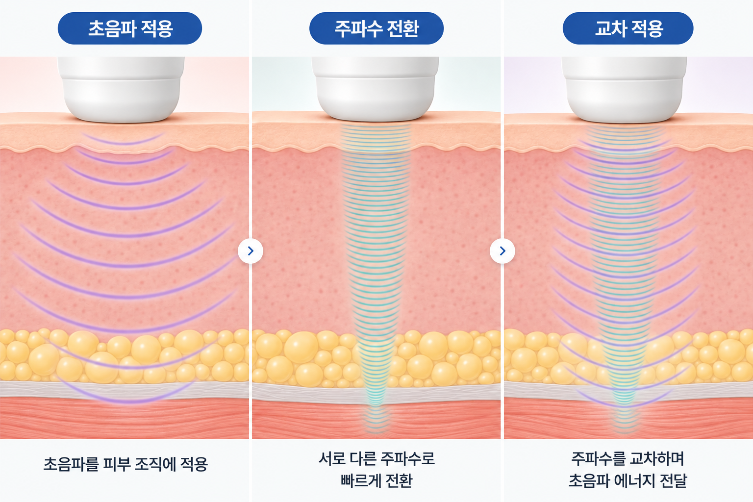 건조한-피부-LDM-초음파-교차-적용-원리