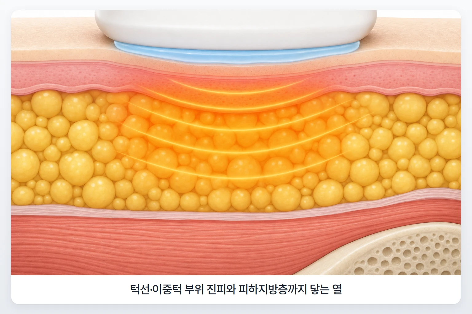 턱선과 이중턱 아래에 엑셀웨이브 핸드피스를 대어 진피와 피하지방층에 열이 퍼지는 모습을 그린 단면도