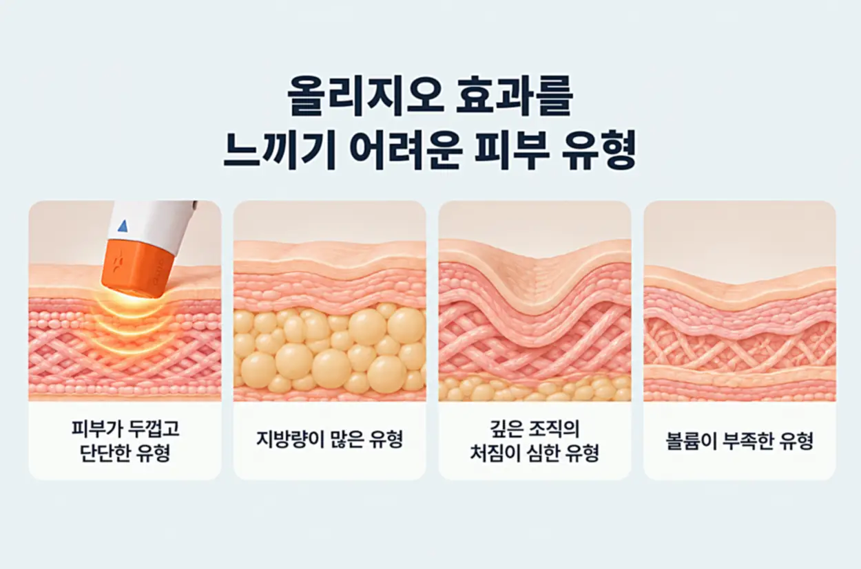 올리지오 효과를 느끼기 어려운 피부 유형 4가지인 두껍고 단단한 피부, 지방량이 많은 피부, 깊은 조직의 처짐이 심한 피부, 볼륨이 부족한 피부를 단면 일러스트로 비교한 이미지