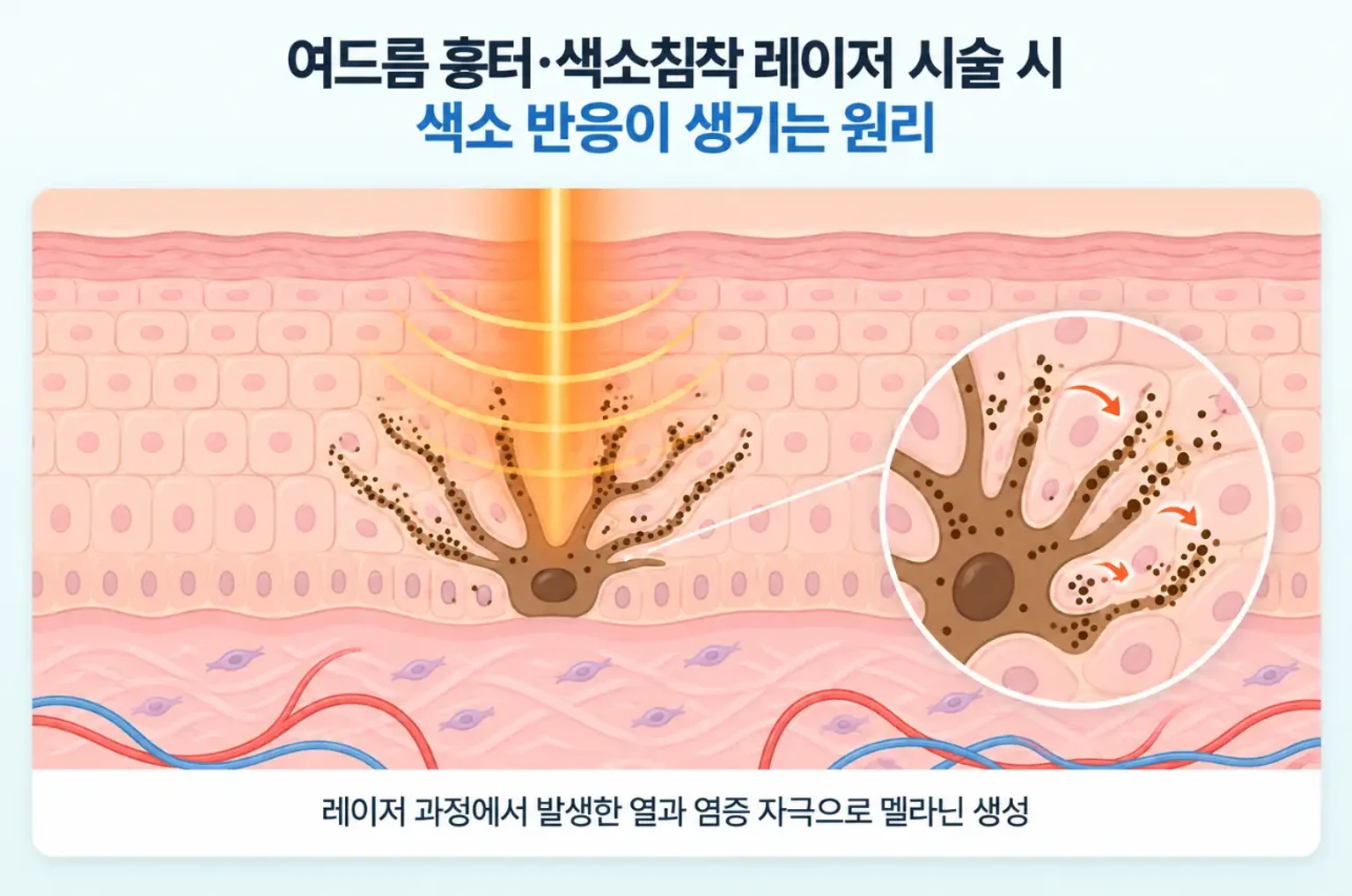 레이저 열과 염증 반응이 멜라노사이트를 자극해 멜라닌이 늘어나는 과정을 나타낸 개념도