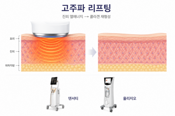 고주파 리프팅의 진피 열에너지 전달과 콜라겐 재형성 과정 및 덴서티 올리지오 장비